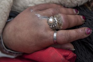 The particular of a gangrenous finger of a woman who sleeps on a bench near Gara de Nord in Bucharest, Romania on November 6, 2011. During the winter hundreds of persons, sleep in the basement of the city to find heat.