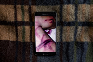 A smartphone shows a picture of the injuries caused by the Croatian Police to Nekib, a 16 years old migrant from Afghanistan inside an abandoned building in Bihac, Bosnia and Herzegovina on January 22, 2021. On November 2020, Nekib was trying to cross the border with Croatia when, according to his testimonies, the Croatian police intercepted him and brutally beat him. Lots of migrants avoid staying inside the Bosnian official refugee camps because of the hard conditions in which they are forced to live and also because the people hosted in the official camps  cannot go out freely.