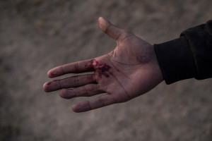 Uahed, 18 years old from Afghanistan shows a wound he got while trying to escape from the Turkish police in Van, Turkey on October 24, 2021. Many Afghan refugees are afraid of being sent back if intercepted by the police.