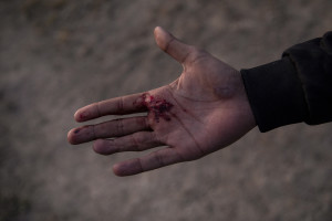 Uahed, 18 years old from Afghanistan shows a wound he got while trying to escape from the Turkish police in Van, Turkey on October 24, 2021. Many Afghan refugees are afraid of being sent back if intercepted by the police.